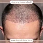 بهترین روش کاشت مو کدام است؟ مقایسه روش‌ها، هزینه و انتخاب کلینیک